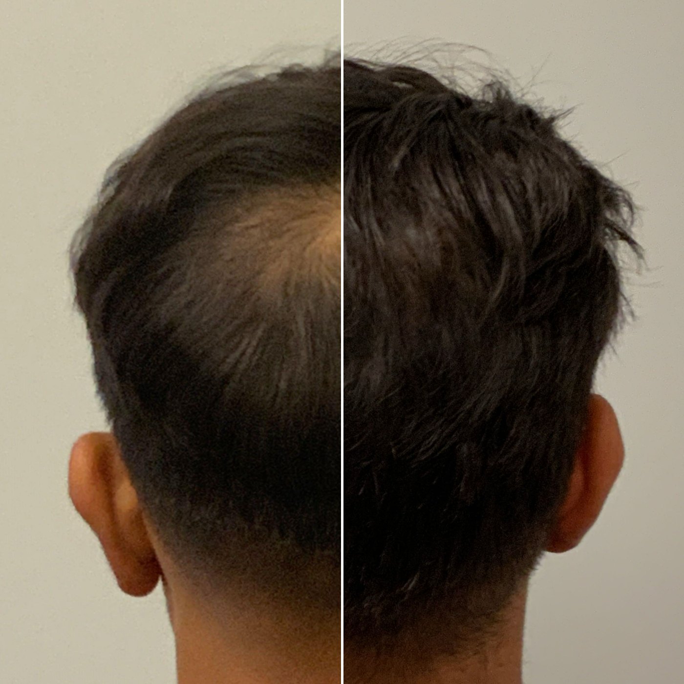 NeoGraft hair restoration: the back of a patient’s head before treatment on the left and after on the right