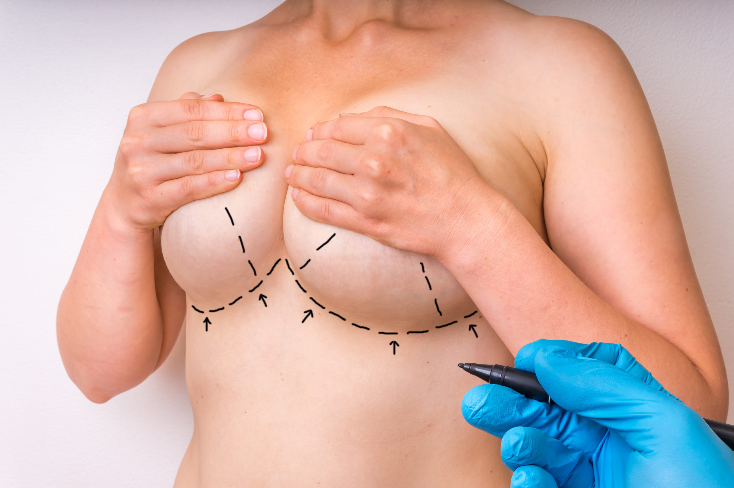 Recovery tips to be kept in mind following the breast reduction